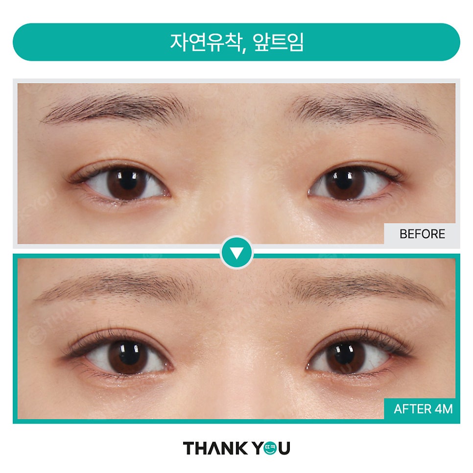 [비절개눈매교정+앞윗트임+눈밑지] 자고 일어났을 뿐인데 제니가?! 관련 이미지 20