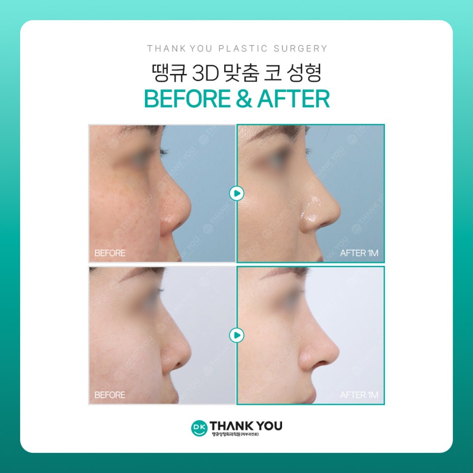 코성형전후, 만족스러운 차이를 얻고 싶다면?! 3D 맞춤 보형물 주목! 관련 이미지 7