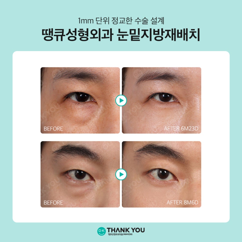 눈밑지방재배치 부작용 예방? 핵심은 1mm의 수술 설계 관련 이미지 7