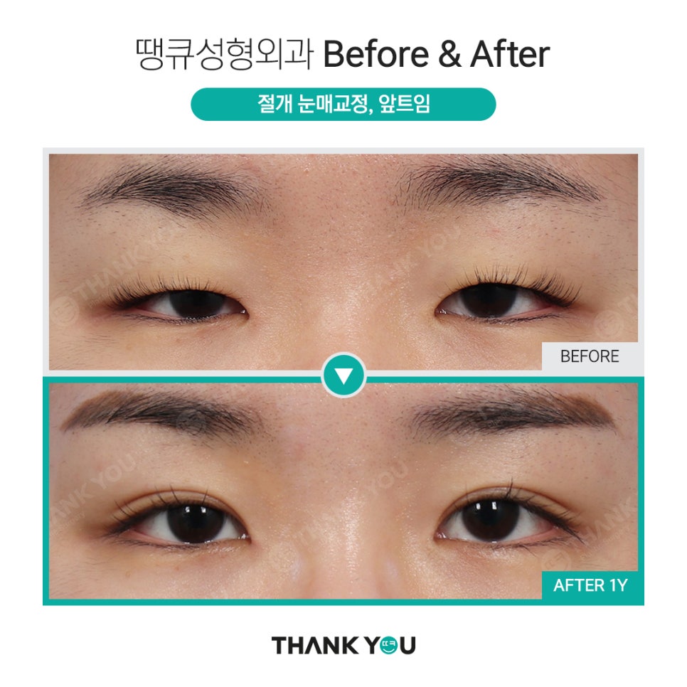 강남쌍수 절개눈매교정 전후와 트임성형 추천 POINT 관련 이미지 6