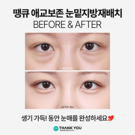 눈밑지전후 애교살에 변화가 생길까? [김다솜 원장 칼럼] 관련 이미지 6