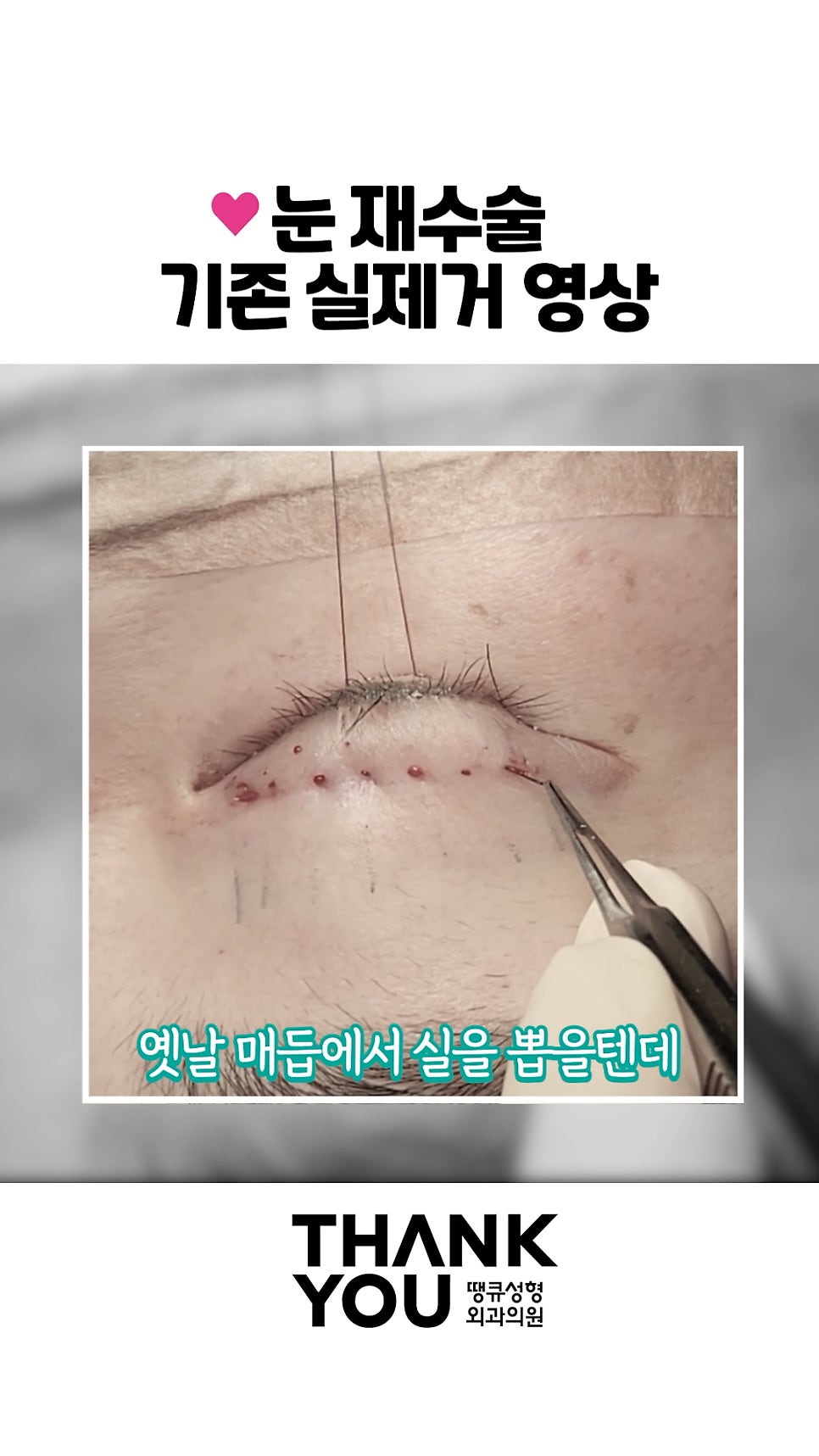 쌍수 풀기 (재수술전 실풀기+ 눈재수술 전후) 관련 이미지 6