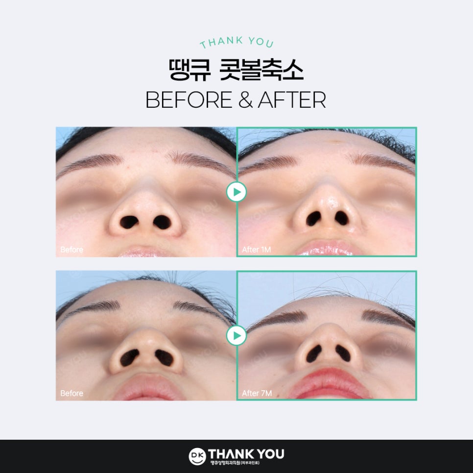 콧볼축소술, 케이스에 따른 맞춤 수술 방법은? 관련 이미지 10