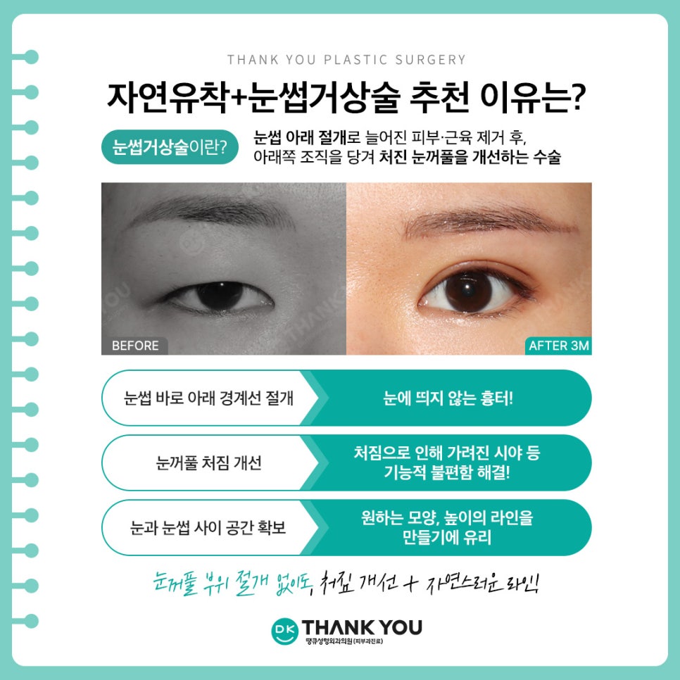 자연유착쌍커풀 + 눈썹하거상술, 자연스러운 라인에 처진 눈 개선까지?! 관련 이미지 3
