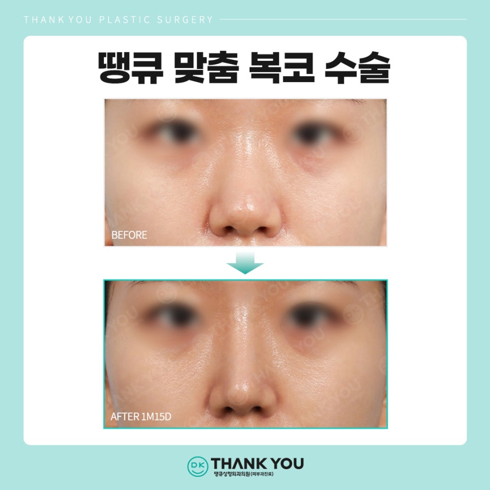 복코수술후기? 세련된 이미지 만드는 땡큐에서 확인! 관련 이미지 10