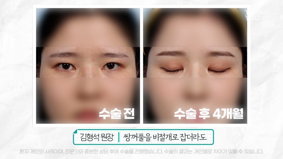 눈재수술 할 때 이마거상 추천하는 이유는? (눈썹올림술 전후) 관련 이미지 20
