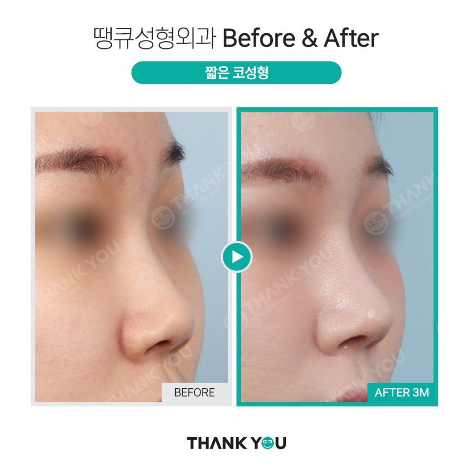 짧은코 교정의 역발상, 짧은코 성형 전후 관련 이미지 4