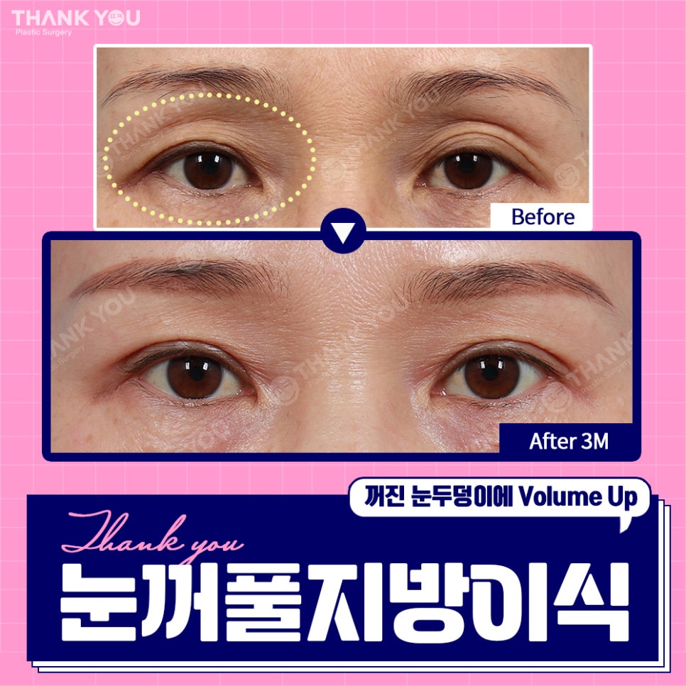 눈꺼짐? Thank You눈꺼풀 지방이식으로 볼륨UP 관련 이미지 7