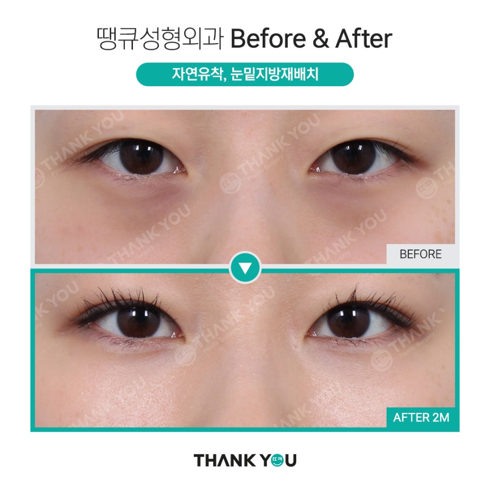 하안검과 눈밑지방재배치의 차이점? 관련 이미지 9