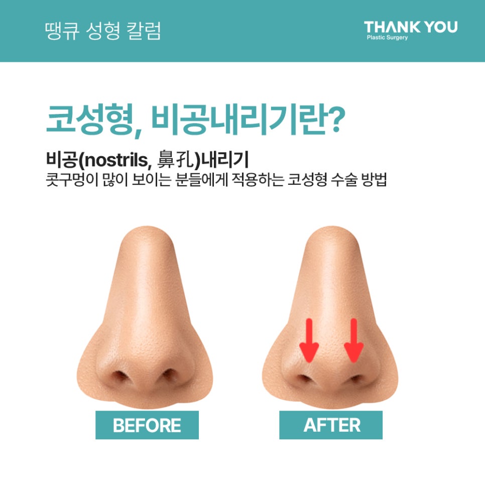 코성형, 비공내리기 수술이란? [콧구멍 잘 보이는 용코 개선] 관련 이미지 2