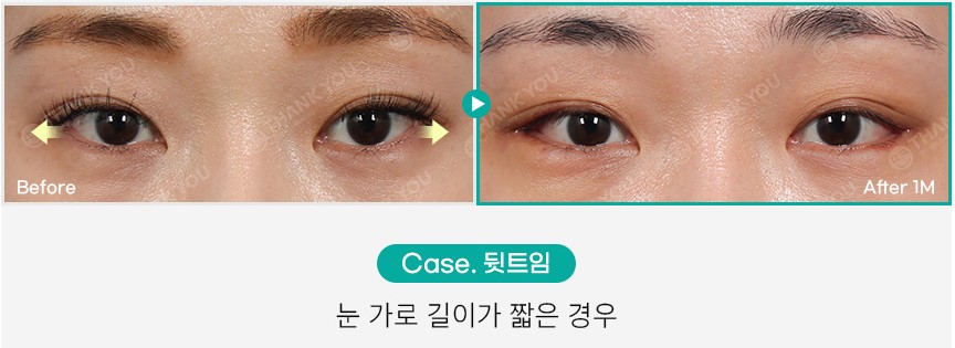 가로로 긴 눈은 어떤 쌍꺼풀라인이 어울릴까요? 관련 이미지 4