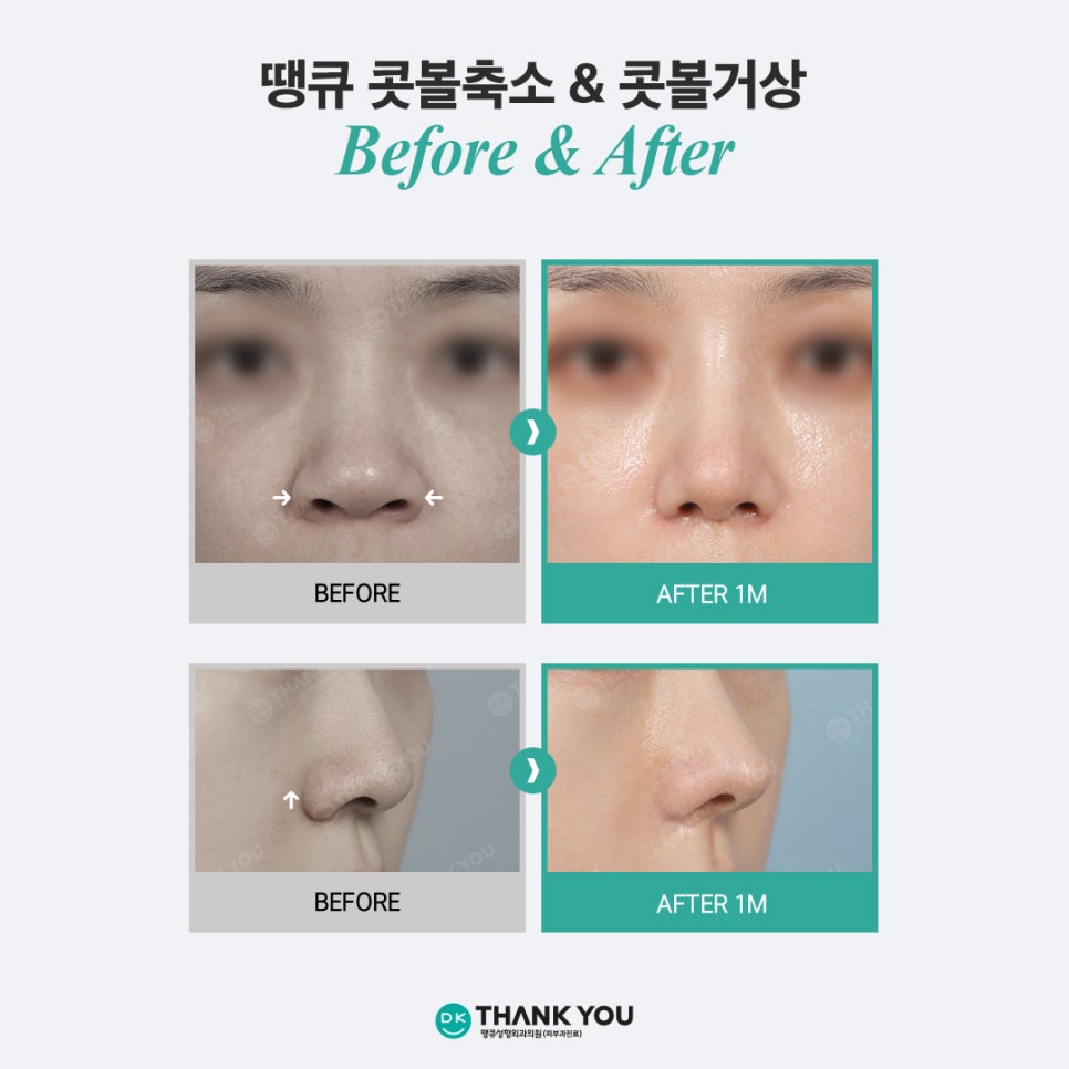 첫코성형 EVENT! 땡큐에서 자연스러운 콧대~코끝 라인 완성! 관련 이미지 9