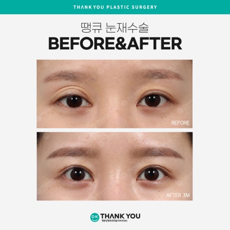 눈재수술병원 선택 시 신중해야 하는 이유는?! 관련 이미지 9