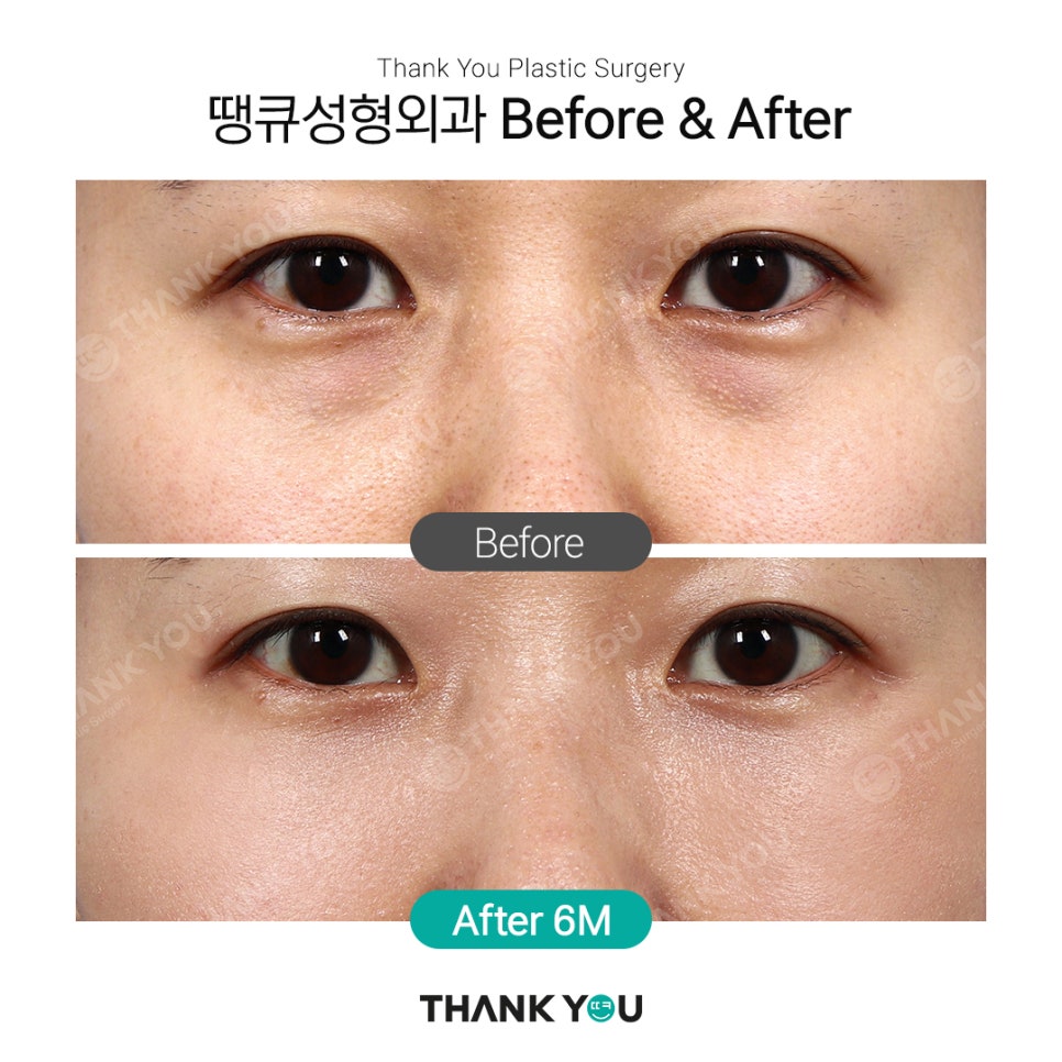 강남 눈밑지방재배치(전후 체크) THANY YOU이벤트 관련 이미지 6