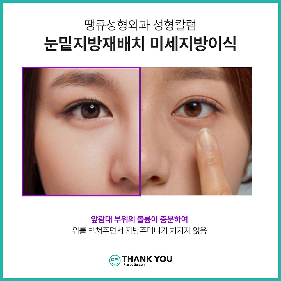 눈밑지방재배치 함께 필요한 미세 지방이식?(땡큐 나노펫) 관련 이미지 3