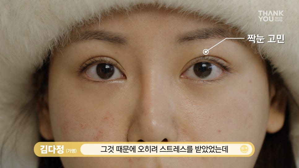 짝눈 교정, 쌍꺼풀 재수술로 깔끔하고 예쁜 라인으로 관련 이미지 15