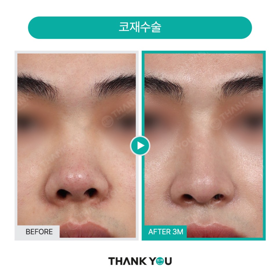 신논현역 성형외과, 남자 휜코성형, 매부리코 성공 포인트는? 관련 이미지 10