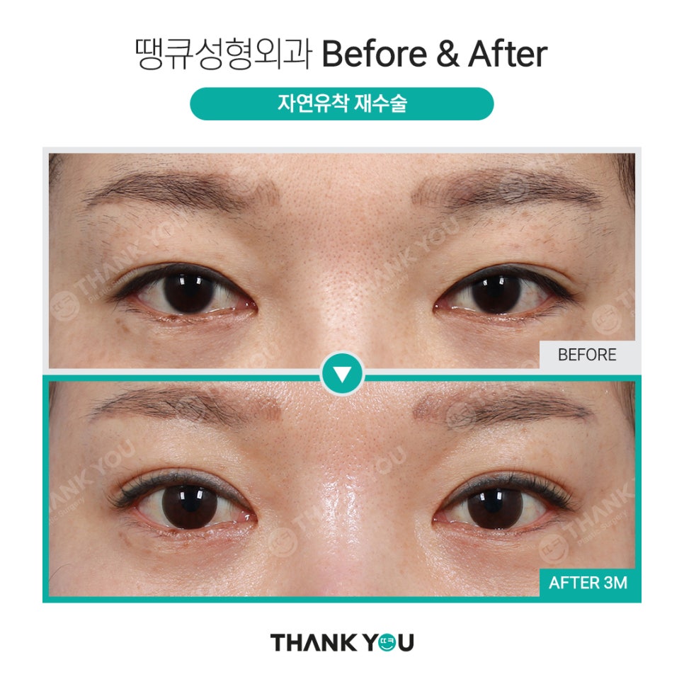실패한 쌍수(겹주름) 눈성형 재수술 전후 사진 Point✨ 관련 이미지 3