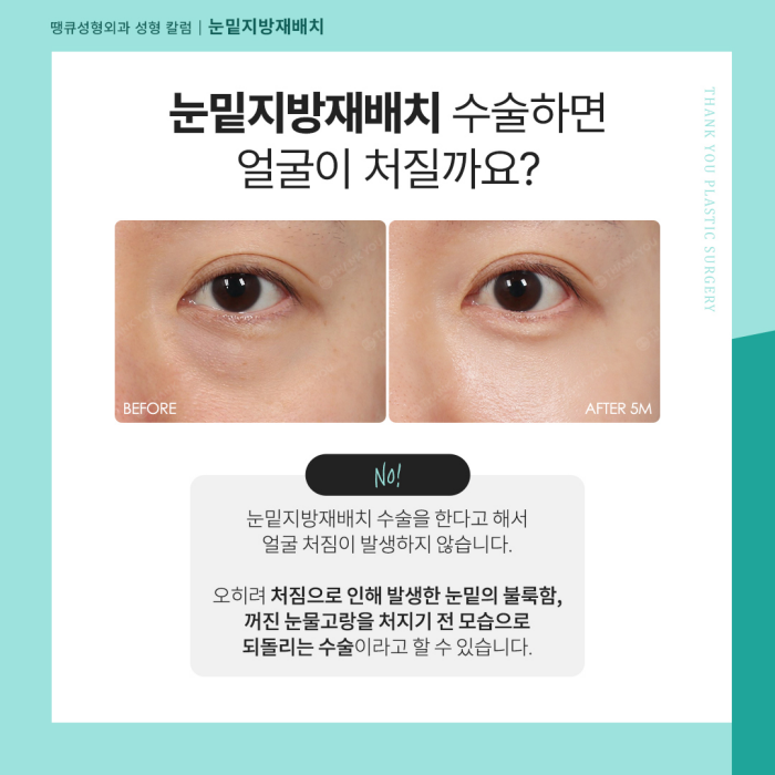 눈밑지 수술 후 얼굴처짐 생길까요? 관련 이미지 4