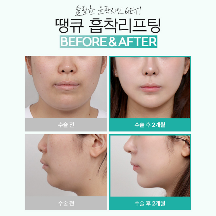 땡큐성형외과 이벤트 : 얼굴윤곽라인 개선엔?! 흡착리프팅 관련 이미지 3