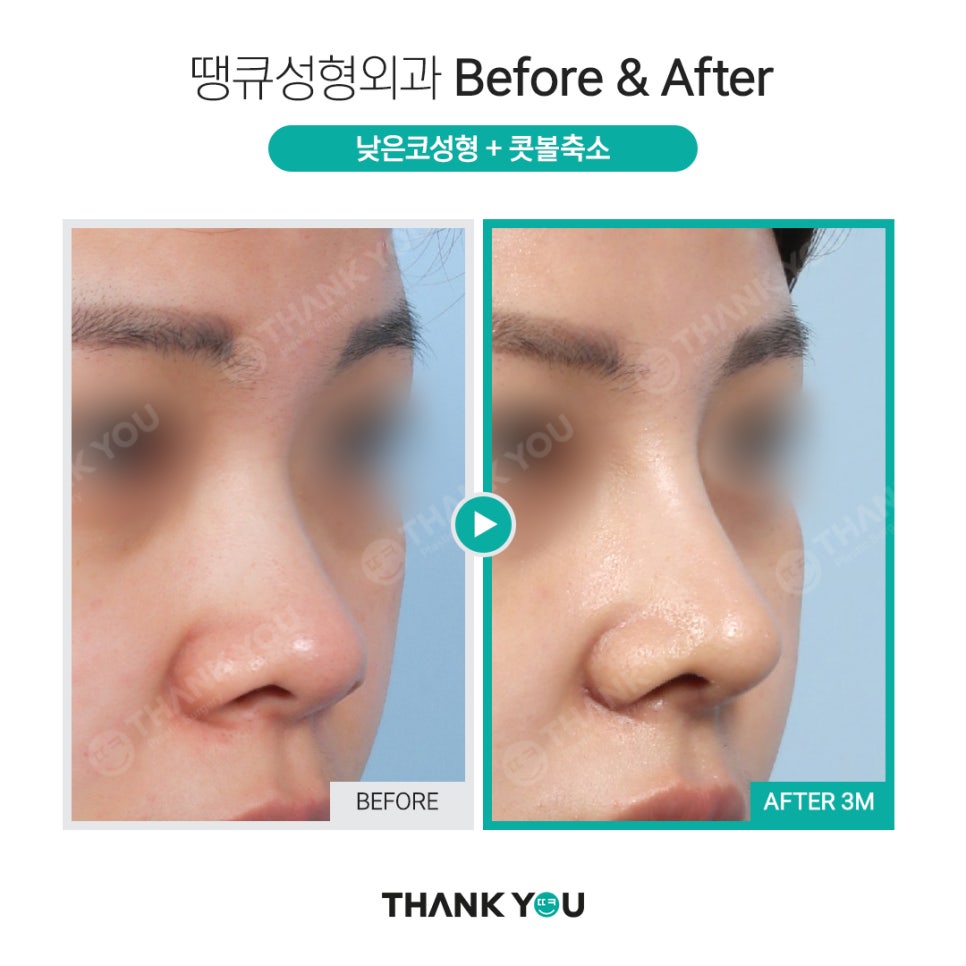 코 성형전, 코필러 꼭 제거해야 하나요? [코 수술전 필독!] 관련 이미지 7
