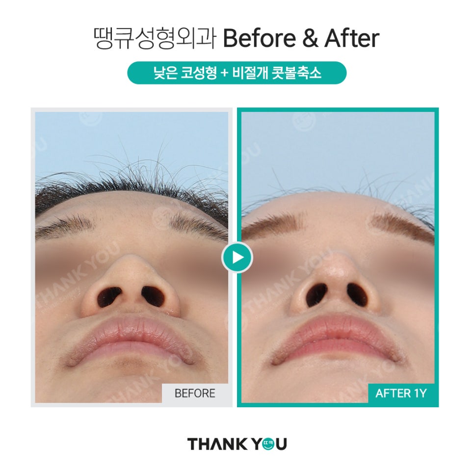 짧은코 교정의 역발상, 짧은코 성형 전후 관련 이미지 10