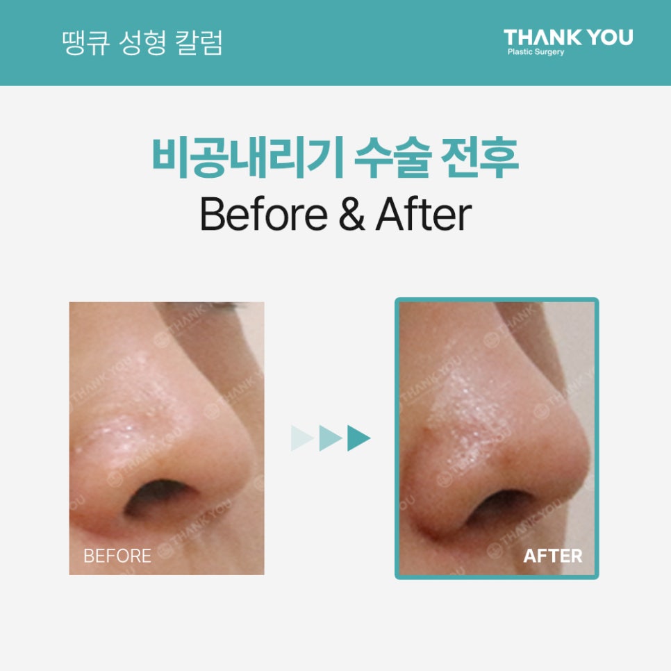 코성형, 비공내리기 수술이란? [콧구멍 잘 보이는 용코 개선] 관련 이미지 3