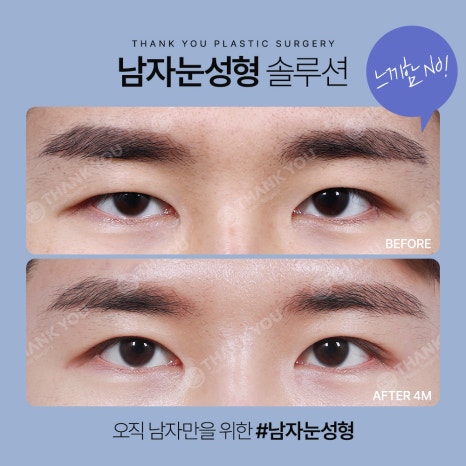 땡큐 남자눈성형 솔루션 (ft. 남자비절개 눈매교정 전후) 관련 이미지 3