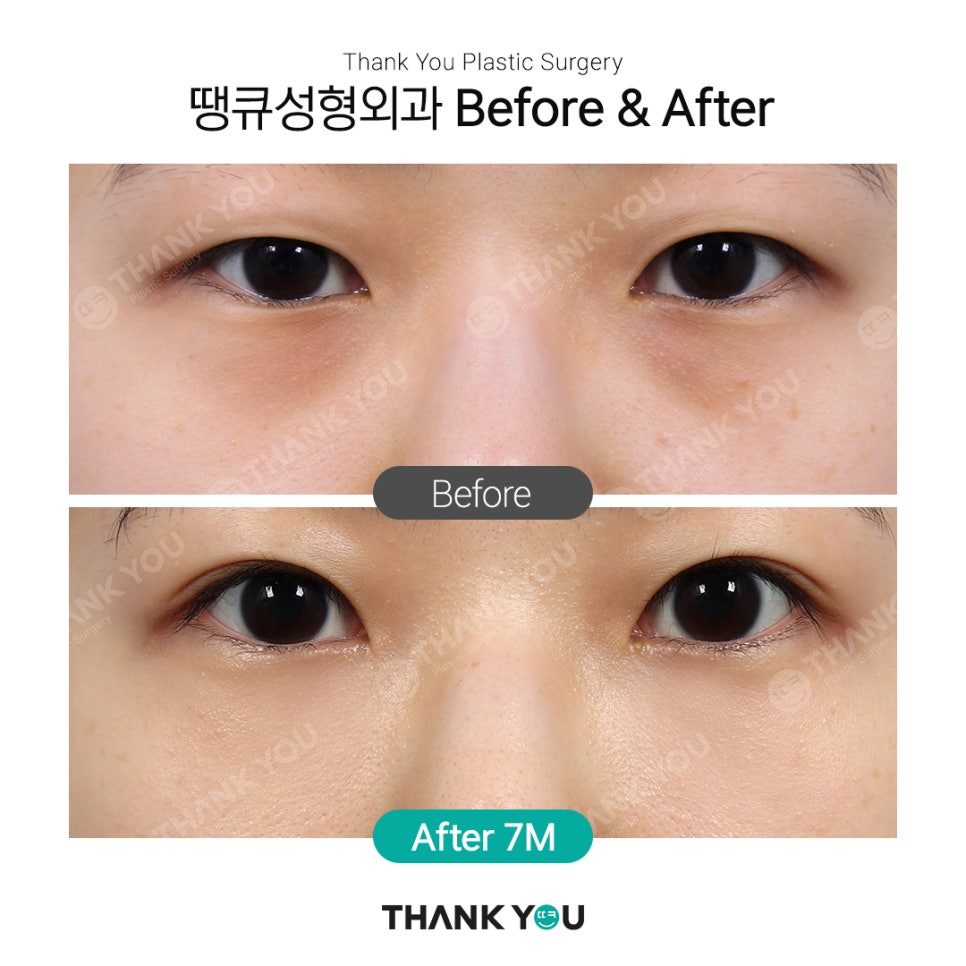 땡큐에서 알려드리는 눈밑지방재배치 Check point ❗ 관련 이미지 8