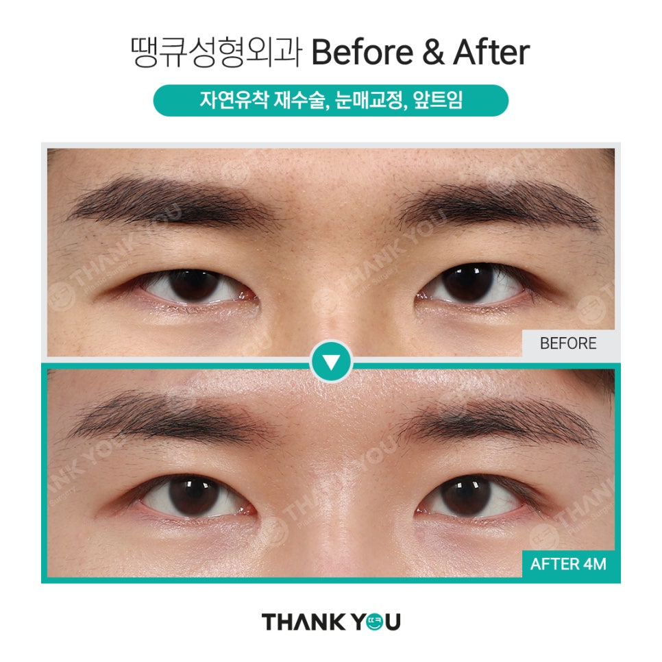 눈매교정 전후? 수술 전후사진으로 체크해요 관련 이미지 8