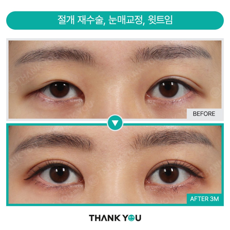 눈재수술 실패하지 않으려면? 눈 재수술유형&전후 체크 관련 이미지 8