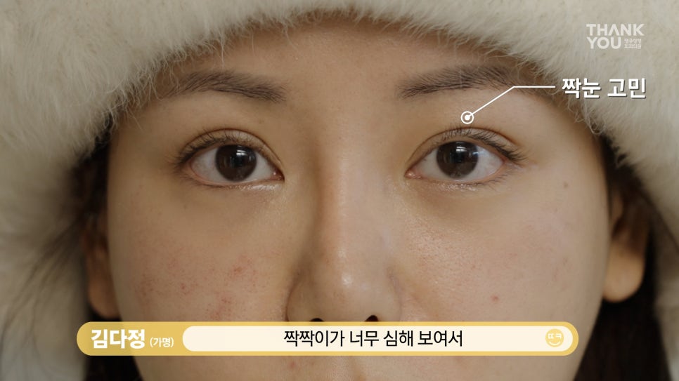 짝눈 교정, 쌍꺼풀 재수술로 깔끔하고 예쁜 라인으로 관련 이미지 14