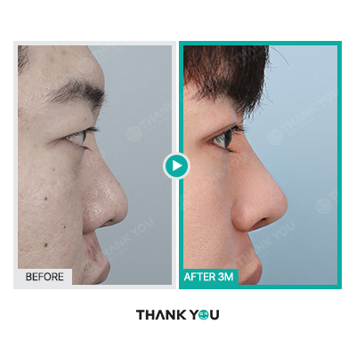 땡큐 맥미남, 뮤지컬배우 남자 복부지방흡입 전후 Check 관련 이미지 7