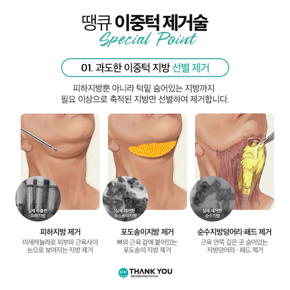 Not Enough Improvement from Chin Liposuction Alone? How About Thank You Double Chin Removal Surgery?! image 9
