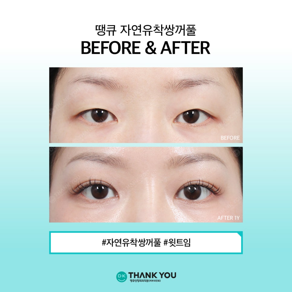 Natural Adhesion Double Eyelids: If You Want Naturalness That Lasts Longer image 9