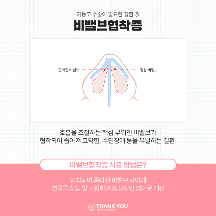 비염기능코수술과 미용코 성형을 동시에! 기능코성형 효과는?! 관련 이미지 5