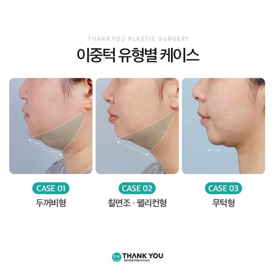 Not Enough Improvement from Chin Liposuction Alone? How About Thank You Double Chin Removal Surgery?! image 5