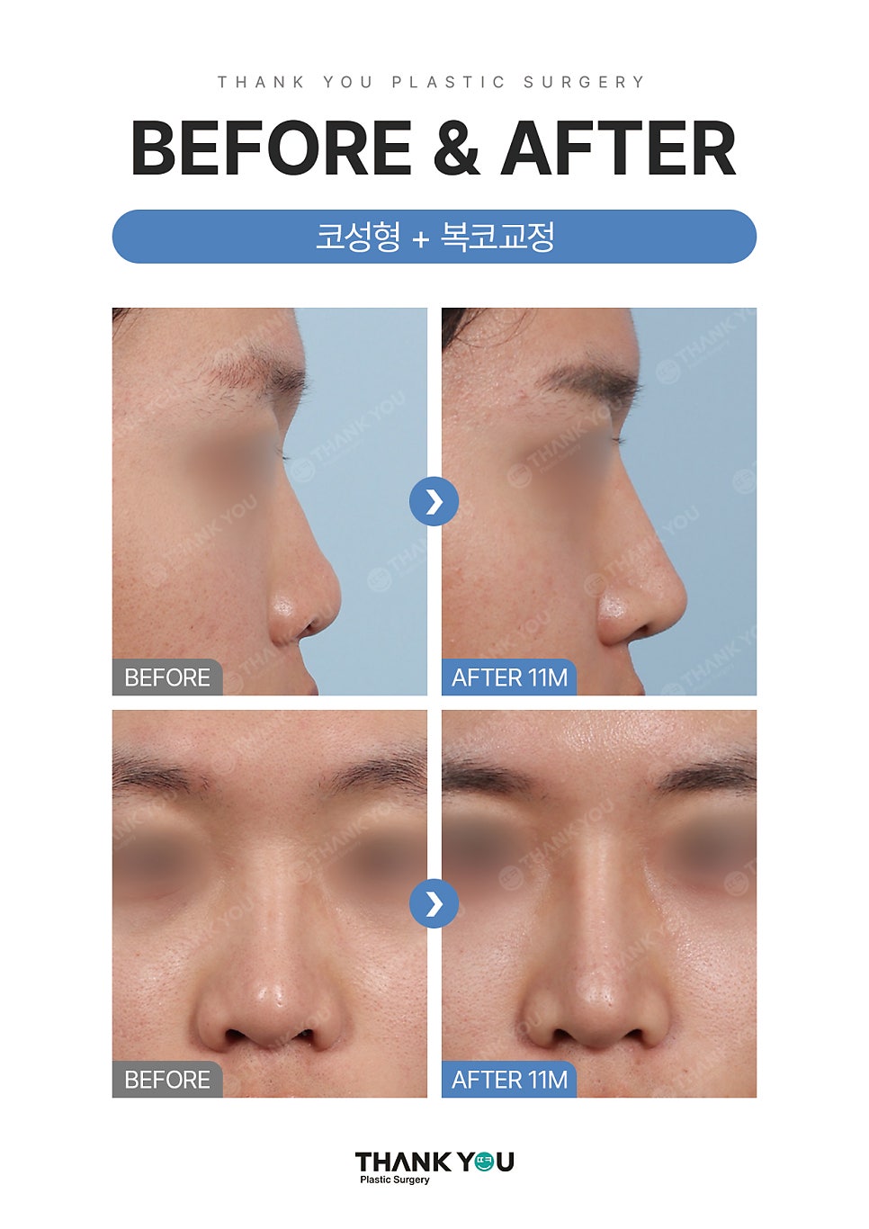 자가늑연골? 기증늑연골? 코성형수술 재료의 끝판왕? 관련 이미지 7