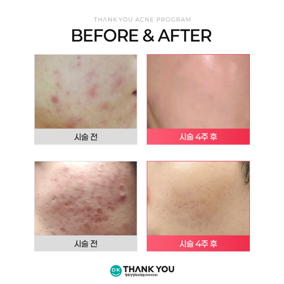 Curious About the Effects of Acne Scaling? Find Out at Thank You! image 5