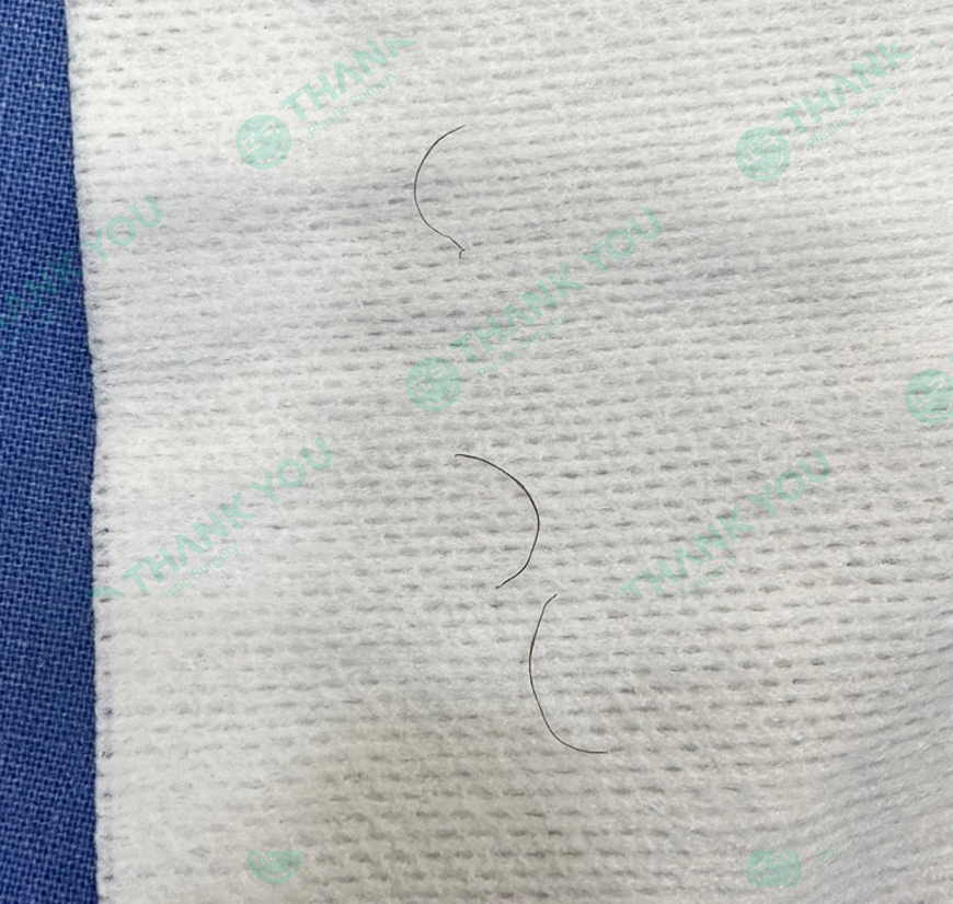 '쌍꺼풀 실 눈찌름'으로 안과? 쌍수실 제거+자연유착 라인 살리는 법 관련 이미지 21