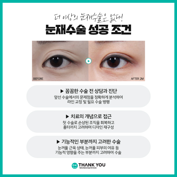 눈재수술전후 만족스러운 차이를 만들고 싶다면?! 관련 이미지 4