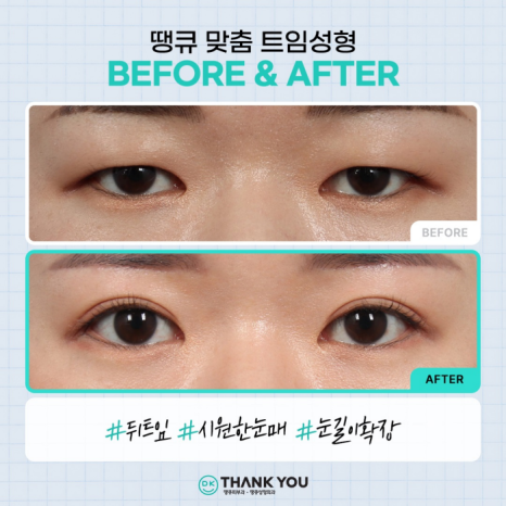 트임성형잘하는곳에서 알려주는 트임 위치별 특징 관련 이미지 6