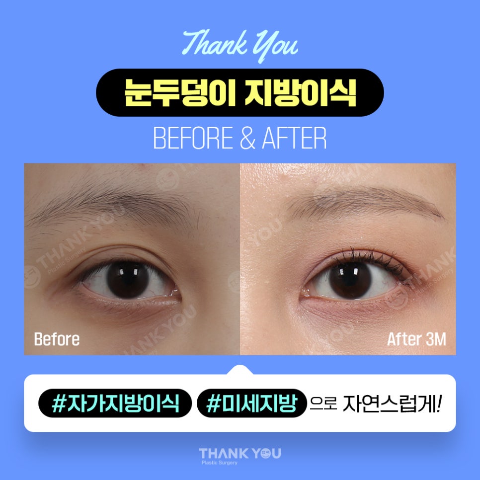 눈두덩이 지방이식, 푹꺼진 눈꺼풀에 자가지방이식으로 관련 이미지 12