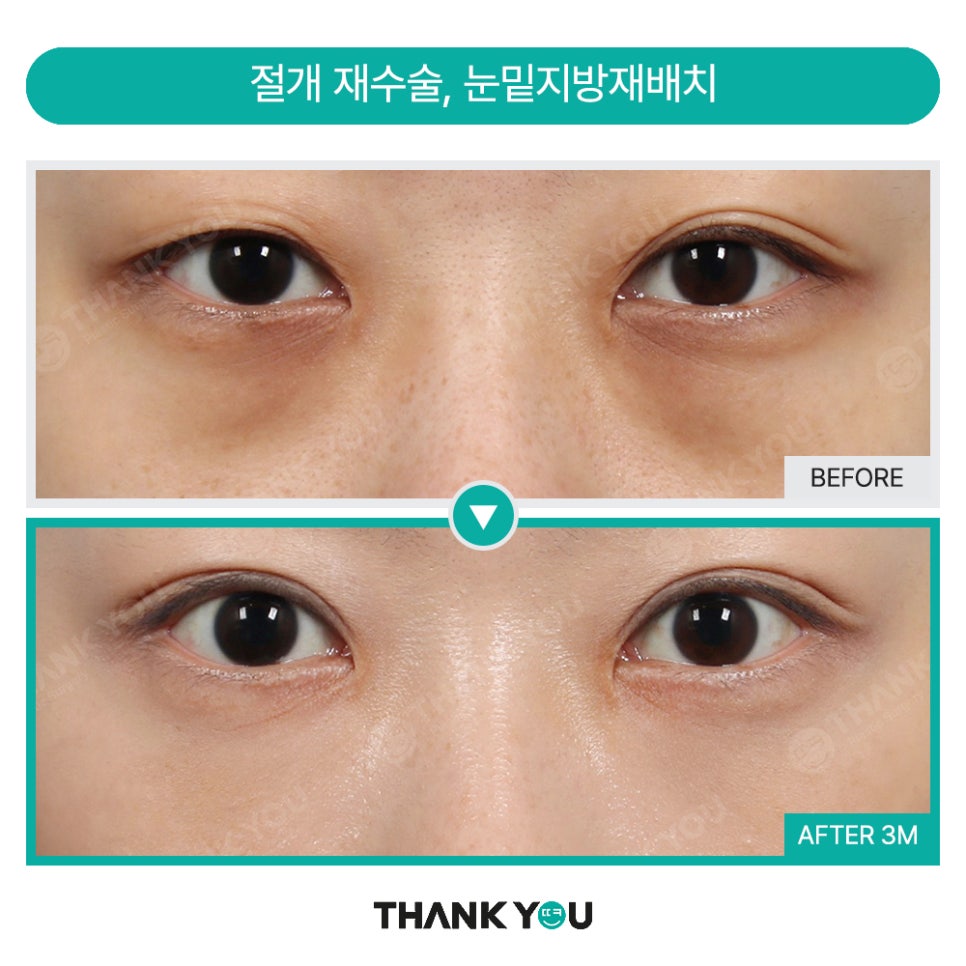 눈재수술 실패하지 않으려면? 눈 재수술유형&전후 체크 관련 이미지 12