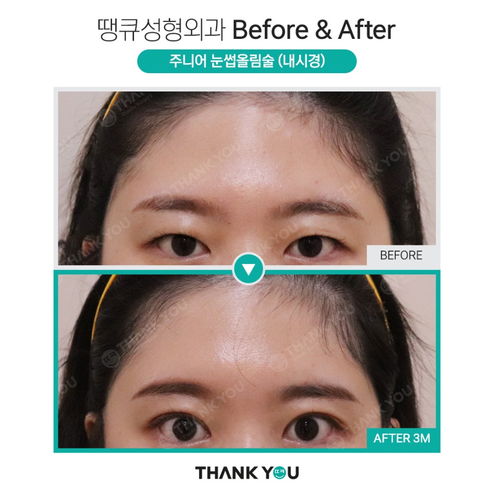 나이가 어린데도 이마거상을 꼭 해야 할까요? 관련 이미지 4