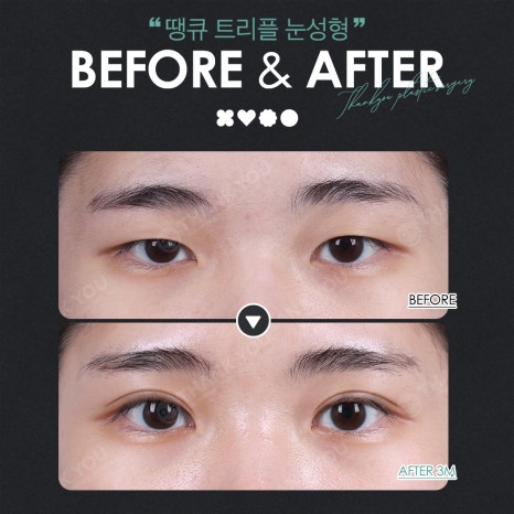 Thank You’s Exam Taker Event at a Great Place for Eye Surgery! ✨Triple Eye Surgery✨ image 10