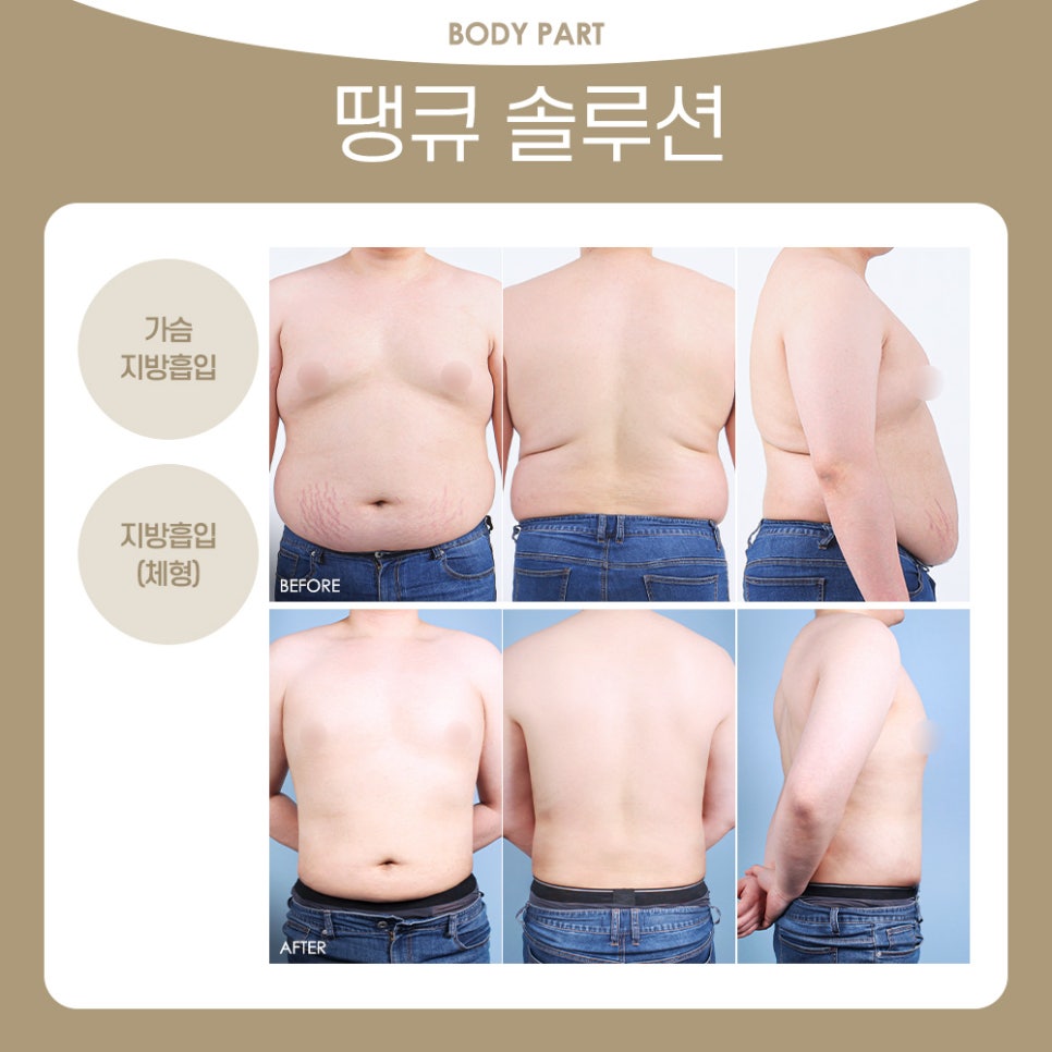 땡큐 맥미남, 뮤지컬배우 남자 복부지방흡입 전후 Check 관련 이미지 3