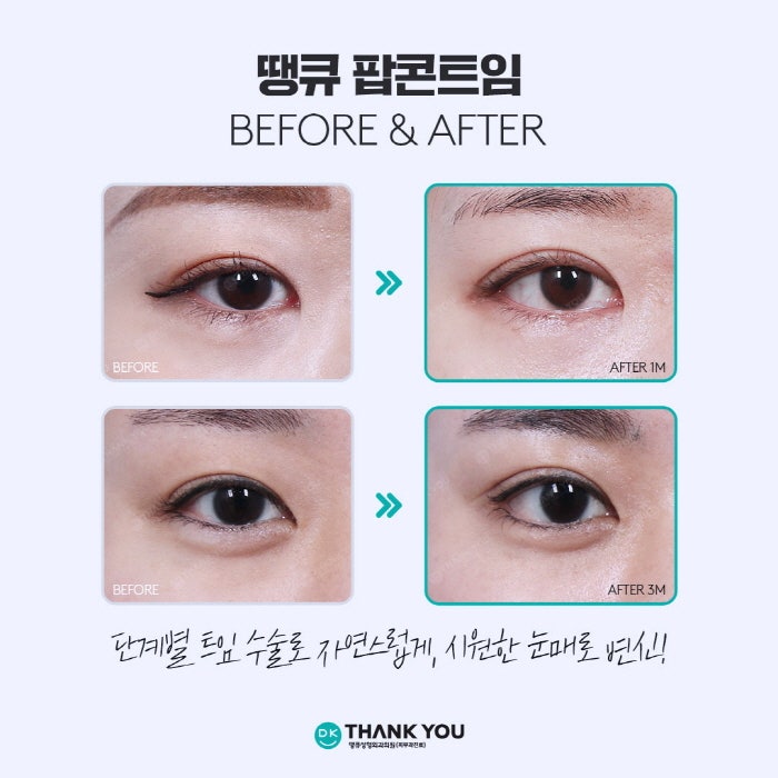 뒤밑트임 수술로 눈의 크기는 물론 이미지 개선까지! 관련 이미지 7