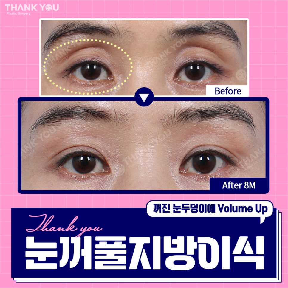 눈꺼짐? Thank You눈꺼풀 지방이식으로 볼륨UP 관련 이미지 4
