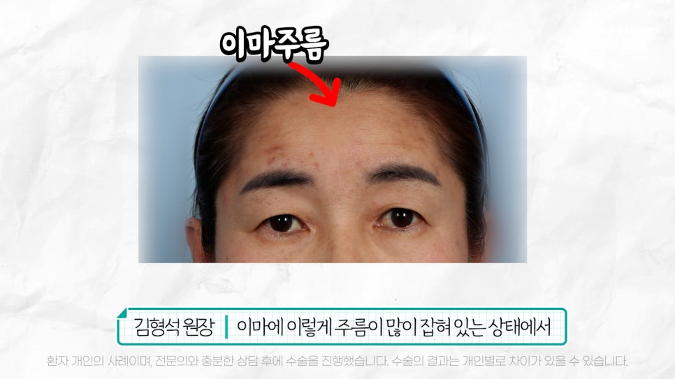 중년눈성형 전후& 이마거상+눈썹하거상+쌍수로 젊어지기 관련 이미지 17